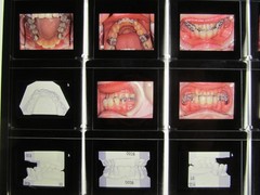 Dentist Dental Technology Braces 91 Special Vintage Slides