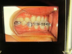 Dentist Dental Technology Braces 91 Special Vintage Slides