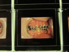 Dentist Dental Technology Braces 91 Special Vintage Slides
