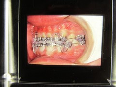 Dentist Dental Technology Braces 91 Special Vintage Slides