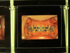 Dentist Dental Technology Braces 91 Special Vintage Slides