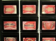 Dentist Dental Technology Braces 91 Special Vintage Slides
