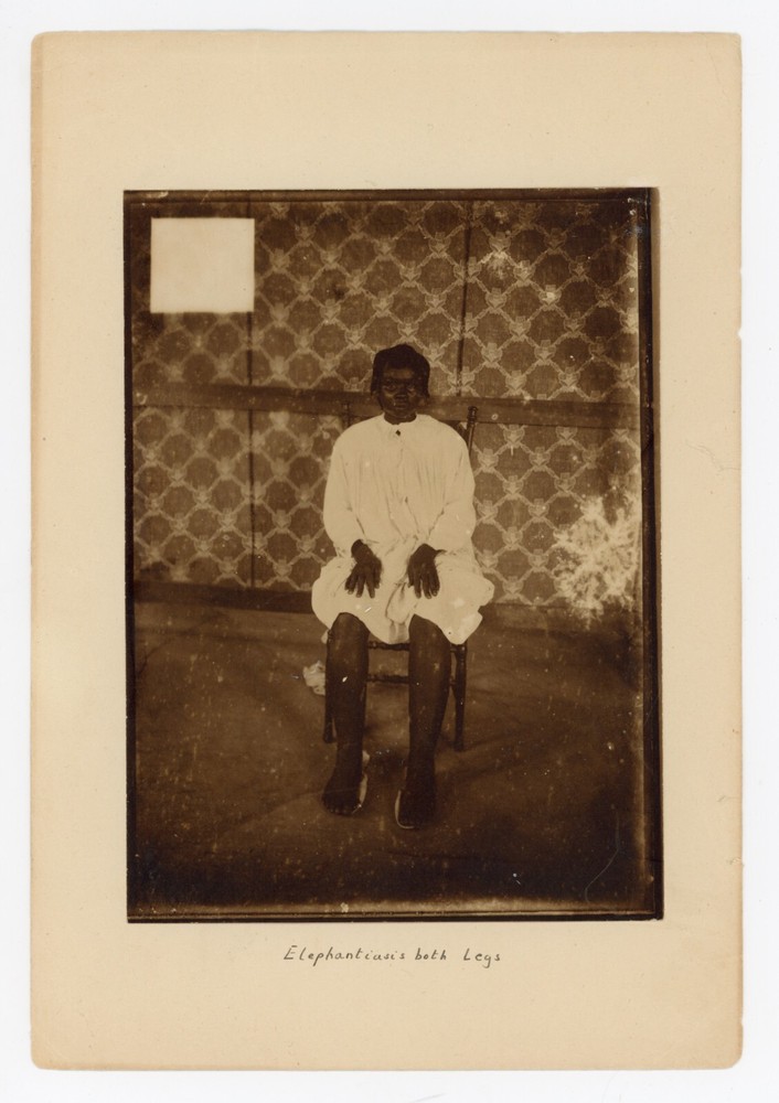 Medical Photo African Girl Elephantiasis 1900 Portrait Vintage Original