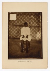 Medical Photo African Girl Elephantiasis 1900 Portrait Vintage Original