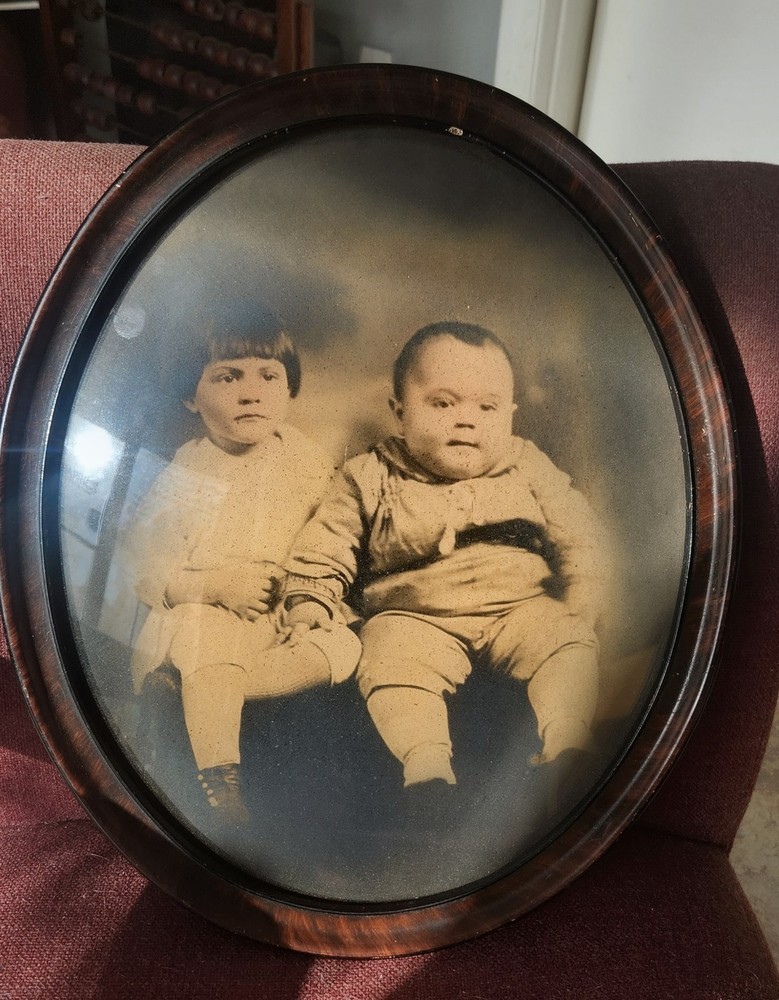 Antique Oval Bubble Glass Photo – Early 1900s Siblings – Medical Curiosity.